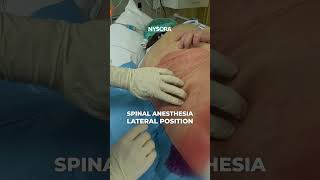 Spinal is best in sick patients anesthesia nerveblock [upl. by Suzette]