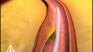 Arterial Stenting  3D Medical Animation [upl. by Efram432]