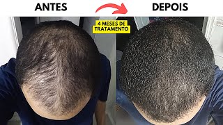 CALVÍCIE MASCULINA RESULTADO DE APENAS 4 MESES [upl. by Weylin]