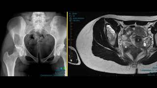 Aneurysmal bone cyst ilium [upl. by Lorens]