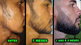 1 ANO E 4 MESES USANDO MINOXIDIL Pant Kirkland e Dom Pelo [upl. by Turnheim850]