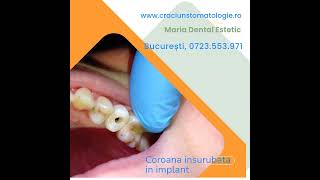 Coroana zirconiu insurubata in implant [upl. by Dorr]