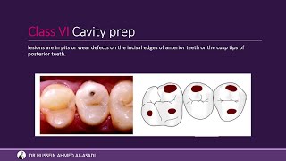 Dental Caries amp Class Of Cavity شرح التسوس ونوع الكلاسات [upl. by Rehposirhc]