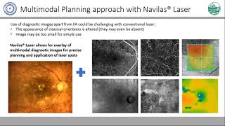 Webinar FA  free planning of navigated laser [upl. by Nirok]