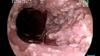 Endoscopic Imaging of Esophageal Verrucous Carcinoma [upl. by Standford327]