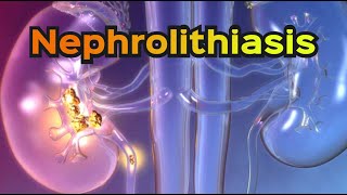 Nephrolithiasis Kidney Stones  CRASH Medical Review Series [upl. by Bashemath]