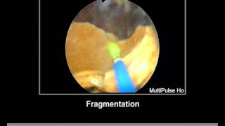 Bladder Stone Holmium Laser [upl. by Okihcas96]