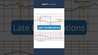 Understanding Late Decelerations in Fetal Heart Rate 🩺 NursingStudents FetalMonitoring [upl. by Naelopan]