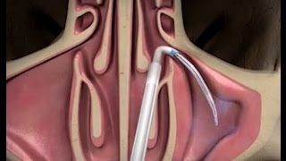 Balloon Sinuplasty Procedure with ENT Dr Timothy Ragsdale [upl. by Adnaw485]