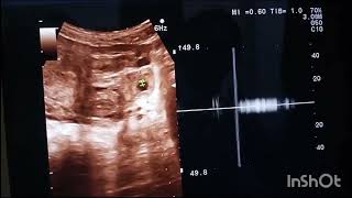 ectopic pregnancy ultrasound [upl. by Scheider629]