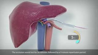 Segment 7partial segment 8 liver resection for HCC [upl. by Garate]