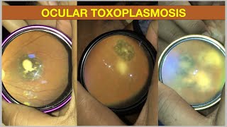 Ocular Toxoplasmosis  Retinochorioditis [upl. by Caterina]