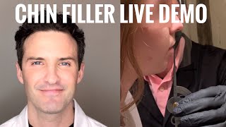 Chin Fillers Live Demo with Explanation [upl. by Eirellam688]