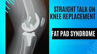 Straight Talk on Knee Replacement  Fat Pad Syndrome [upl. by Nylyaj]