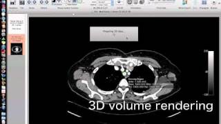 OsiriXsimulated Navigation S1lung segmentectomy [upl. by Macmahon]