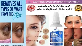 Wart Remover Ointment reviews  Does wart removal really work  Massa kaise hataye  Honest Review [upl. by Wenoa]