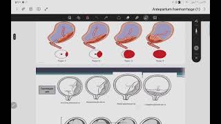 نسائية  Antepartum haemorrhage [upl. by Annavoeg820]