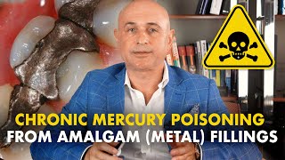 Amalgam metal fillings Common symptoms of chronic mercury poisoning [upl. by Ainoet]