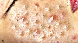 Big Cystic Acne Blackheads Extraction Blackheads amp Milia Whiteheads Removal Pimple Popping  9180 [upl. by Yenetruoc]