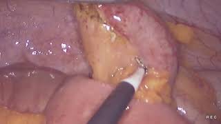 Laparoscopic appendectomy unedited 882024 [upl. by Ashjian]