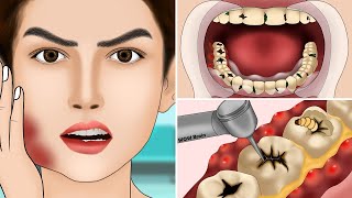 ASMR Molar Tooth Caries Removal so Satisfying part3  Dental Care Animation  어금니 우식증 제거 너무 만족 [upl. by Ydna802]