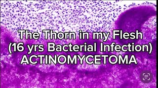 The Thorn in My FleshActinomycetoma 16yrs bacterial infection [upl. by Lian]