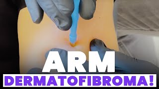 ARM DERMATOFIBROMA [upl. by Revlys]