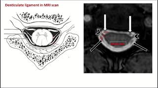 Denticulate ligaments pia mater [upl. by Aihsilef]