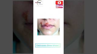 Ever seen these Blisters on someones face Find out what they are herpes dental face [upl. by Notlrac]