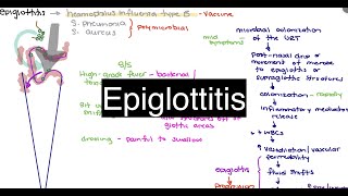 Epiglottitis [upl. by Auqinimod]