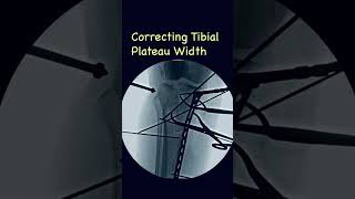 Correcting tibial plateau width in proximal tibia fractures ortho justortho trauma fracture [upl. by Ultan]