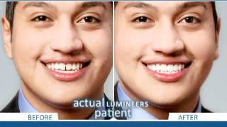 Get an Attractive Smile with PainFree Lumineers by Michael J Wei DDS PC  Manhattan Dentist [upl. by Anzovin]