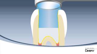 DENTSPLY UK How to place SDR bulkfill composite [upl. by Seagrave]