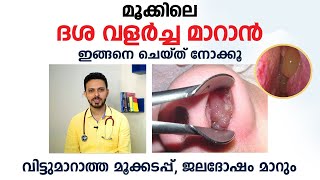 മുക്കിലെ ദശ മാറാൻ  Nasal Polyps Malayalam  Arogyam  Dr Fasi Mohammed [upl. by Arahsit358]