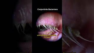 Conjuntivite bacteriana [upl. by Otha]