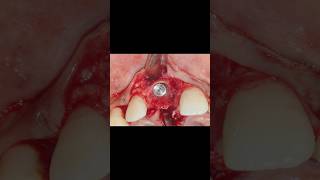 Immediate Implant placement  Luxator extraction Osseodensification  Bone Grafting PERIO SUBHARTI [upl. by Domela]