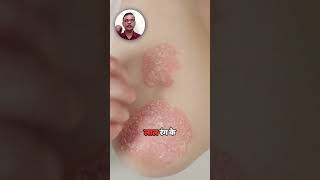 Types of Psoriasis Know the Difference with Dr Mukesh Shah [upl. by Kerred]