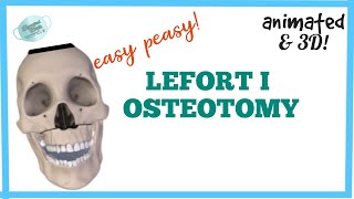 LEFORT I OSTEOTOMY  MAXILLARY OSTEOTOMY [upl. by Ihdin386]