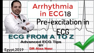 ECG from A to Z intermediate level Arrhythmia 18 Dr Alaa Nasr 2019 [upl. by Leahcimnaj]