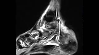 The double line sign is a pathognomonic MRI for [upl. by Eerot]