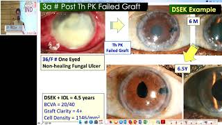 AIOC2019  IC134  Endothelial Keratoplasty DSEK DSAEK and DMEK – Made Simple [upl. by Alikee]