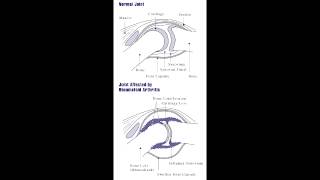 Lab or Diagnostic Findings Rheumatoid Arthritis inflammation joint pannus boutonniere deformity [upl. by Akamahs]