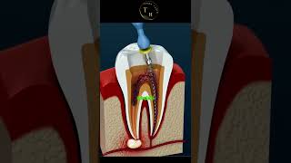 DİŞLERDE Kanal tedavisi science teknoloji bilim [upl. by Tait]