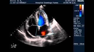 Pericarditis AgudaTaponamiento Cardiaco Dr Pedro Guillermo Bustos 12 Julio 2011 [upl. by Yekciv844]