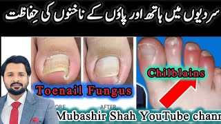 Miracle Treatment For Toenail Fungus amp Chilblains  سردیوں میں ہاتھ اور پاؤں کی انفیکشن سے حفاظت [upl. by Notgnirra]