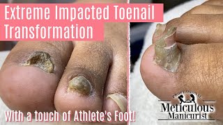 👣How to Pedicure on Extreme Impacted Toenail with Major Transformation 👣 [upl. by Campagna]