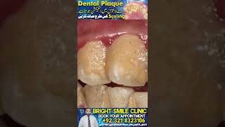 dental plaque se Danton Mein infection Hota Hai  the 1 top remedy for dental plaque [upl. by Karilynn]