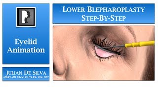 Blepharoplasty Animation – How is Lower Blepharoplasty Eyelid Surgery completed [upl. by Denton740]