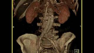 Aortic Stent Graft 3D imaging of a vascular stent in satisfactory position [upl. by Analak]