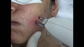 Besenreiser Couperose und Rosacea entfernen mit NdYagLaser [upl. by Anaejer]